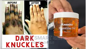 KENNITE Knuckles Gel . (Ondoa Madoa Vidoleni )
