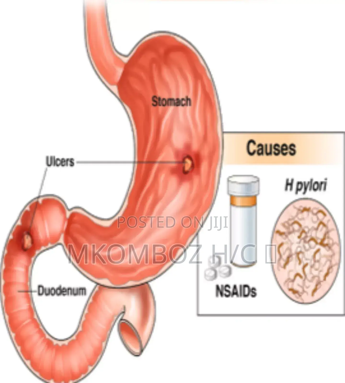 Peptic Ulcers Diseases, Tunatibu Na Kumaliza Pud