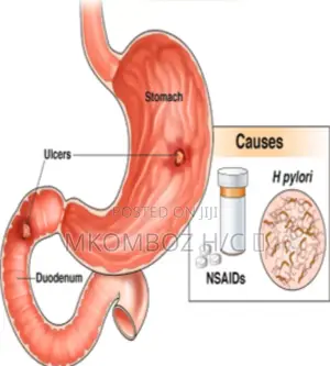 Peptic Ulcers Diseases, Tunatibu Na Kumaliza Pud