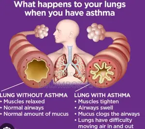 Tunatibu Na Kumaliza Pumu(Asthma) Kwa Siku 14 Tu