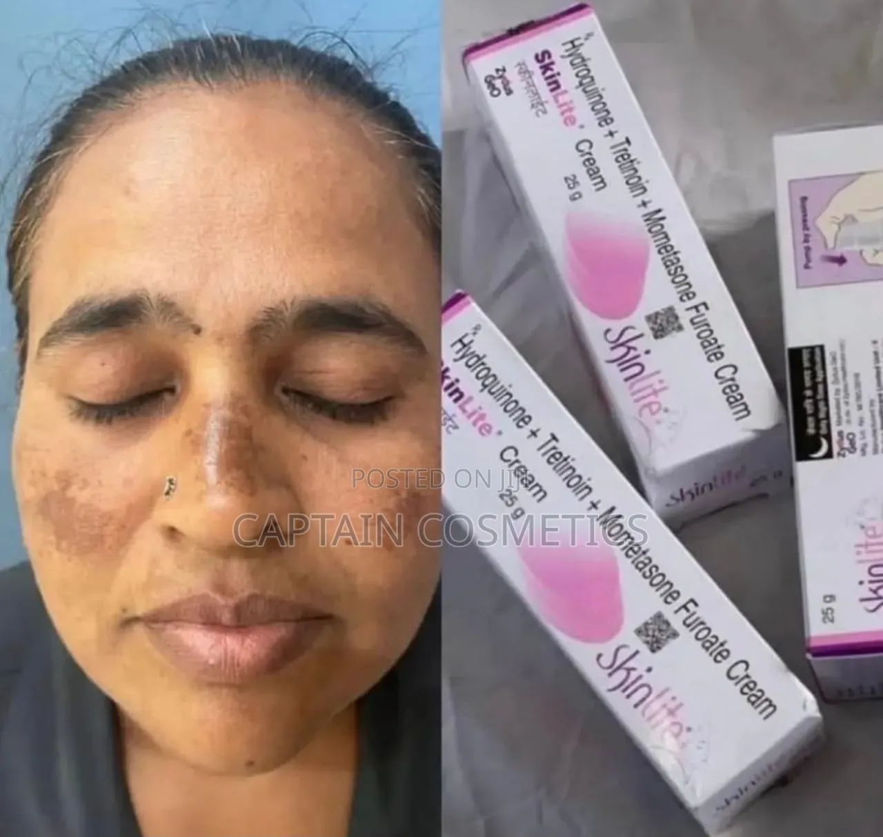 SkinLite Cream – Msaada Kwa Ngozi Yenye Madoa Ya Melasma